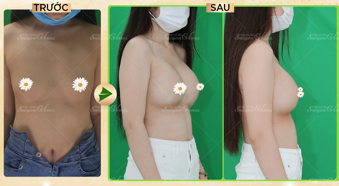 thẩm mỹ sài gòn venus