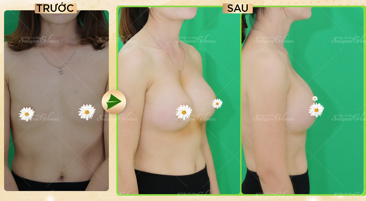 thẩm mỹ sài gòn venus