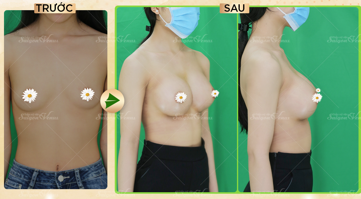 thẩm mỹ sài gòn venus