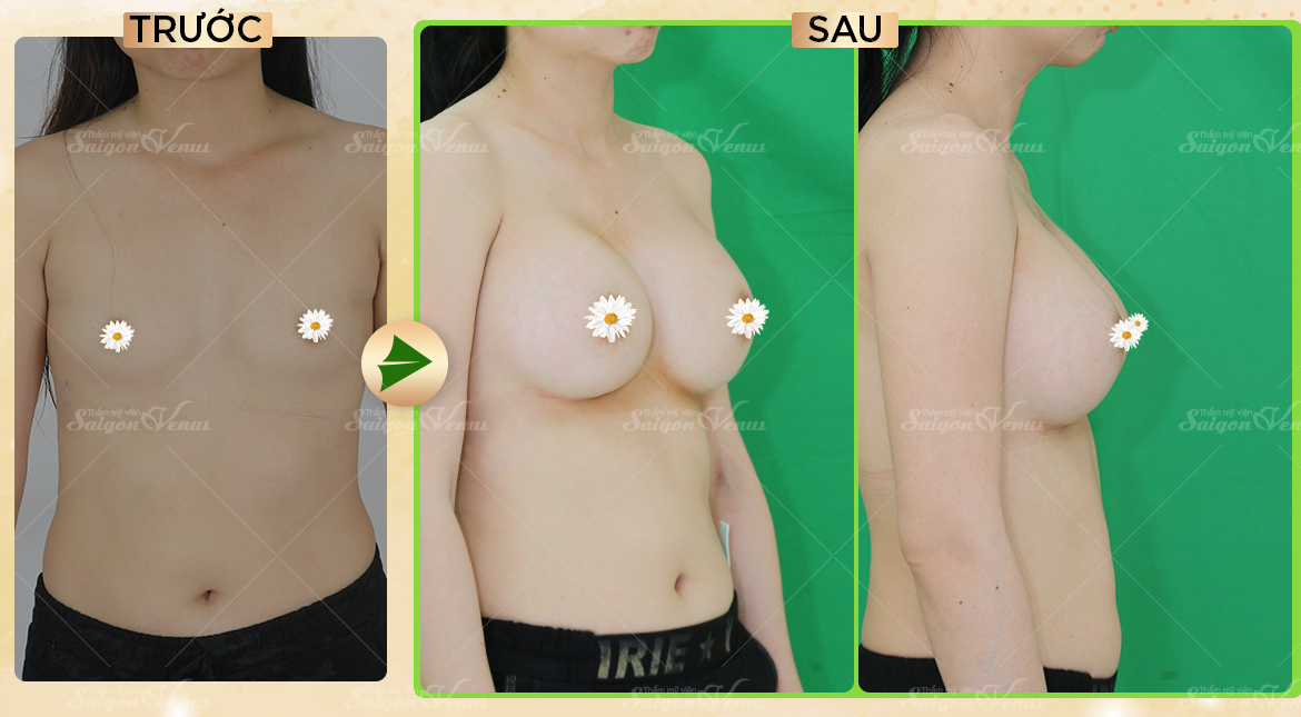 thẩm mỹ sài gòn venus