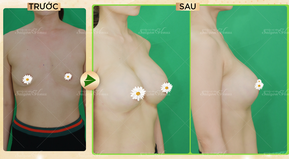 thẩm mỹ sài gòn venus