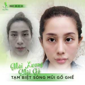 Mài xương mũi gồ – Tạm biệt sóng mũi gồ ghề