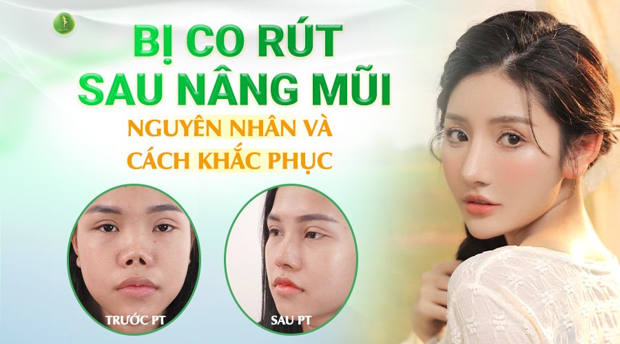 BIẾN CHỨNG BỊ CO RÚT SAU NÂNG MŨI
