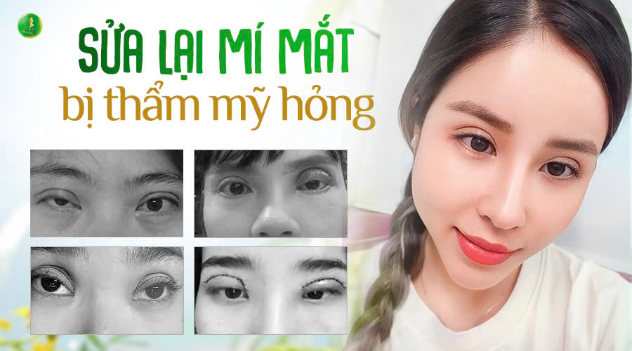 SỬA LẠI MÍ MẮT BỊ THẨM MỸ HỎNG