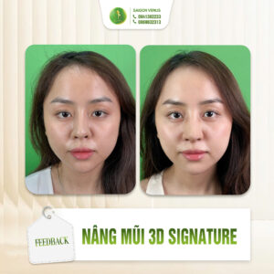 BÍ QUYẾT SỞ HỮU DÁNG MŨI CÁ NHÂN HÓA VỚI 3D SIGNATURE