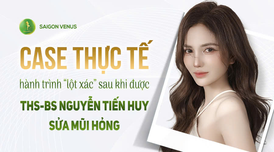 Case Thực Tế: Hành Trình Lột Xác Sau Khi Được ThS-BS Nguyễn Tiến Huy Sửa Mũi Hỏng