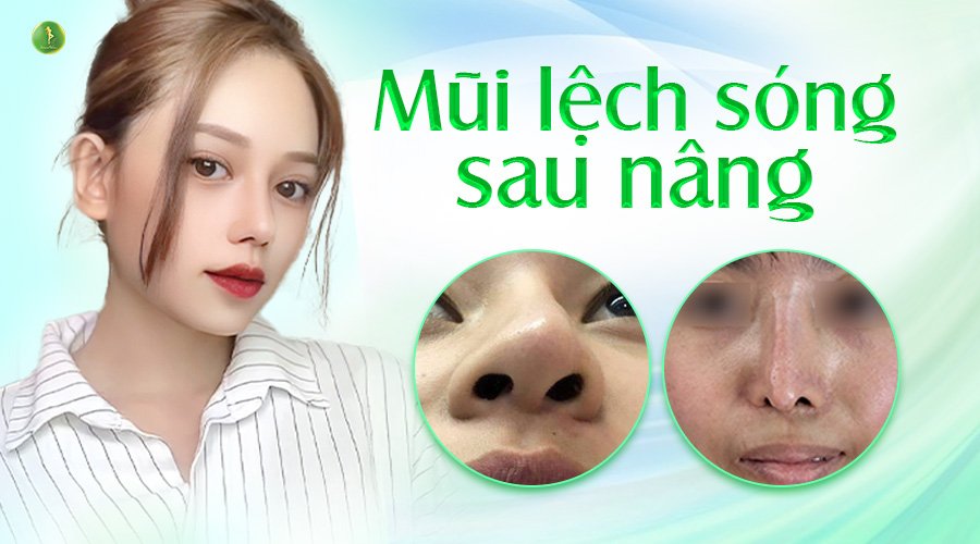 MŨI LỆCH SÓNG SAU NÂNG