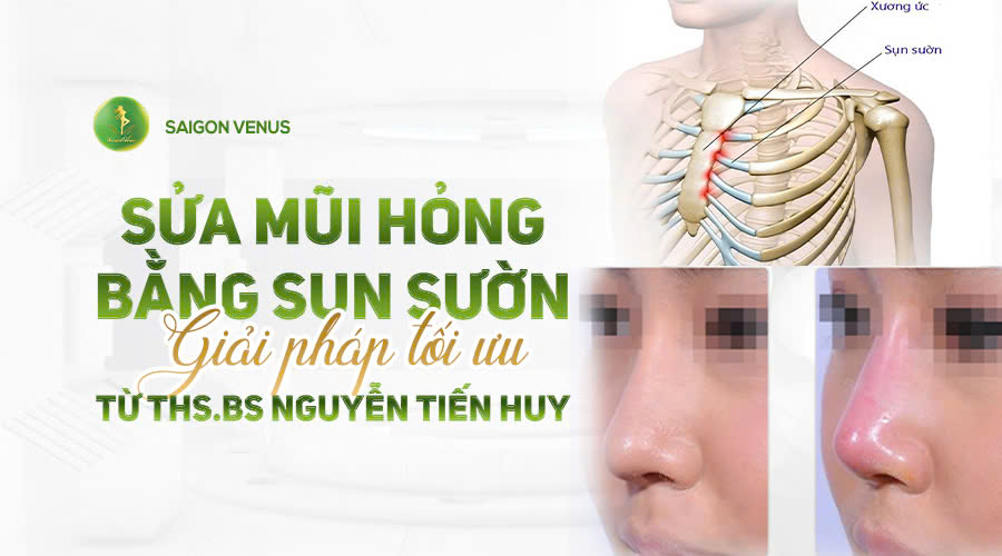 Sửa Mũi Hỏng Bằng Sụn Sườn: Giải Pháp Tối Ưu Từ ThS-BS Nguyễn Tiến Huy