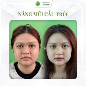 SAIGON VENUS THAY ĐỔI CÔ GÁI TỪ CHIẾC MŨI NGUYÊN THỦY ĐẾN “CỰC PHẨM” BỀN VỮNG
