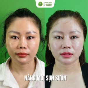 HỒI SINH CHIẾC MŨI CO RÚT BIẾN DẠNG: HÀNH TRÌNH TÌM LẠI “BẢN NGUYÊN” BỀN VỮNG TẠI SAIGON VENUS